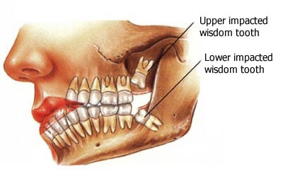 wisdom teeth removal healing process pictures